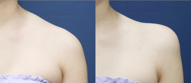 Botox cơ thang vai trước và sau