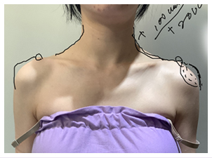 Đầu xương đòn lộ rõ, góc cạnh